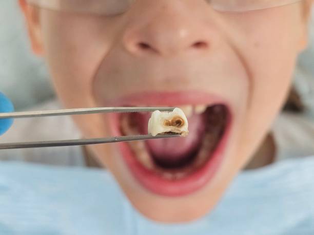 Best Dentist for Tooth Abscess  in Stillwater, MN
